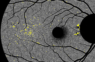 retina (002)